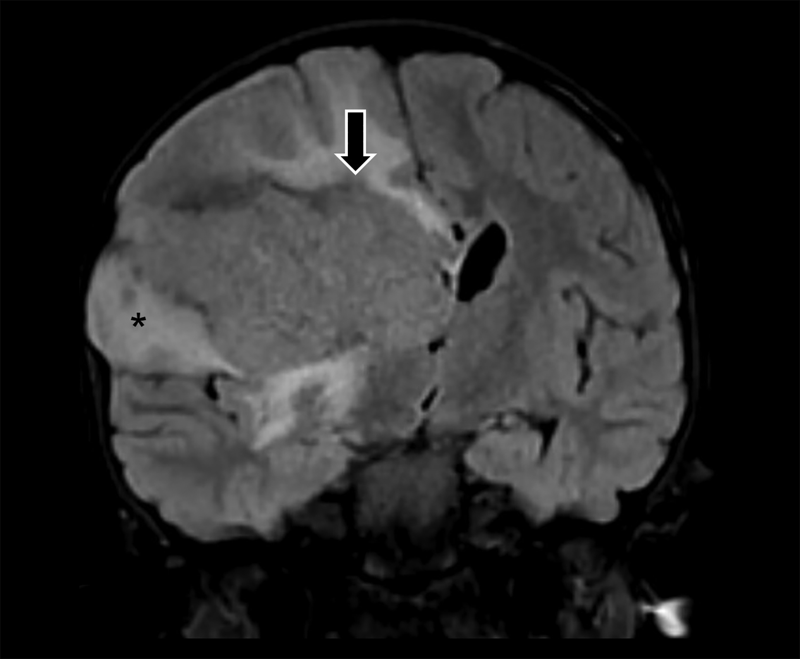 Periventricular Schwannoma • APPLIED RADIOLOGY