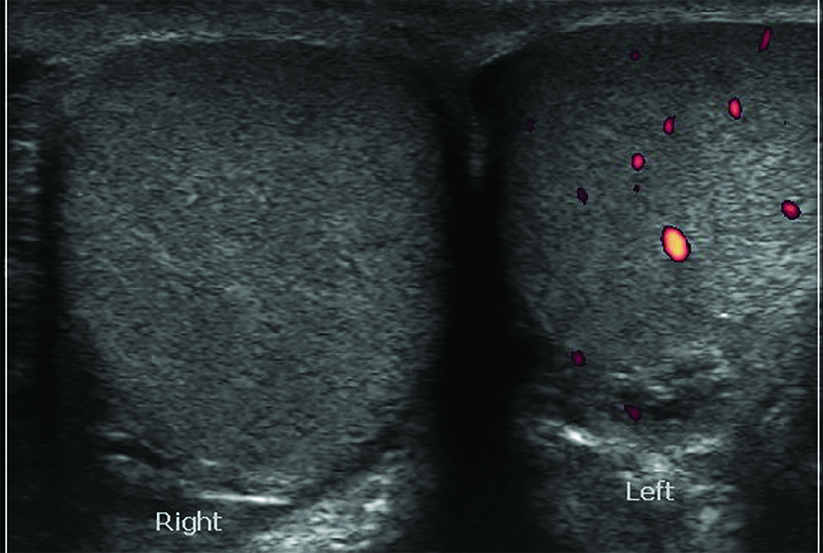 Testicular Torsion Cremasteric Reflex at Nancy Gibson blog