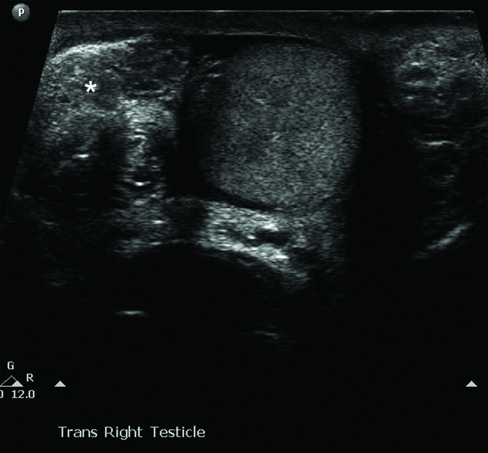 Imaging Testicular Torsion • Applied Radiology