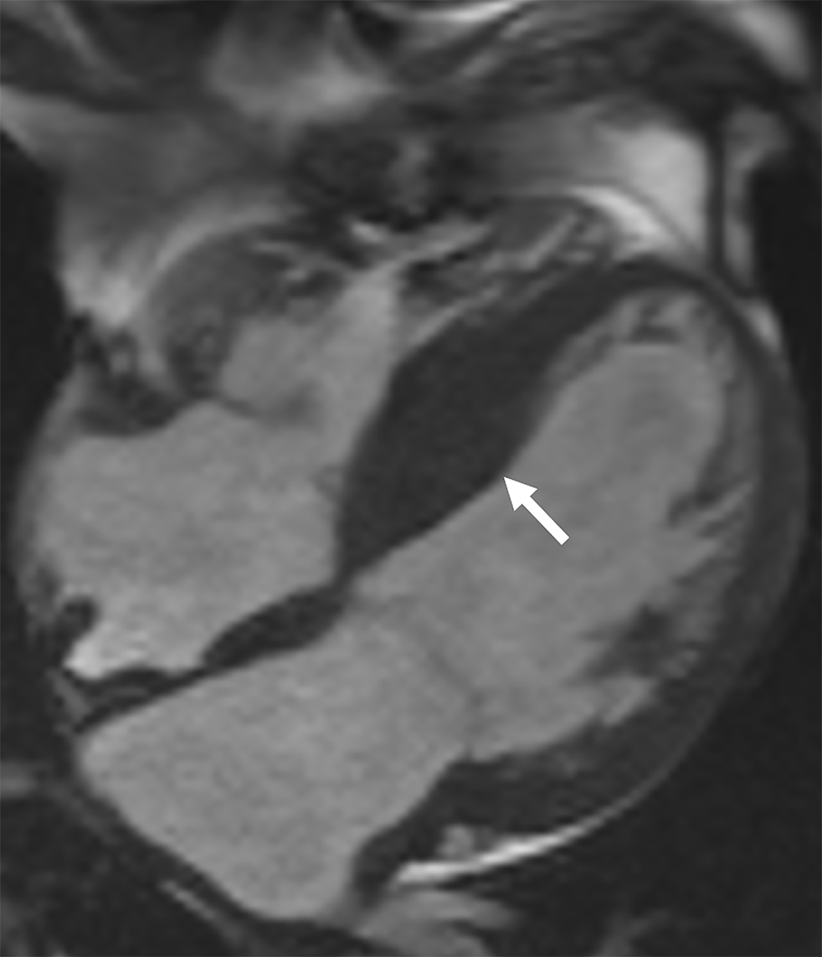 Patterns of CMR measured longitudinal strain and its association with late  gadolinium enhancement in patients with cardiac amyloidosis and its mimics, Journal of Cardiovascular Magnetic Resonance