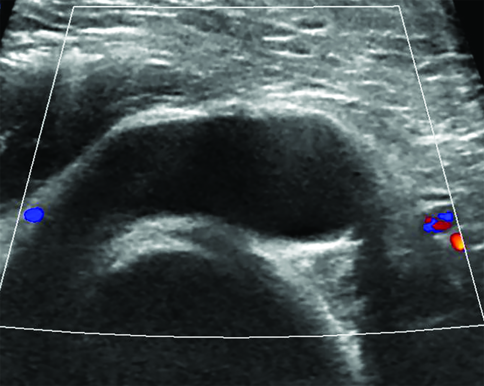 Shoulder Effusion As Ultrasound Mimic Of Axillary Lymphadenopathy   LangmanRC Figure02c 