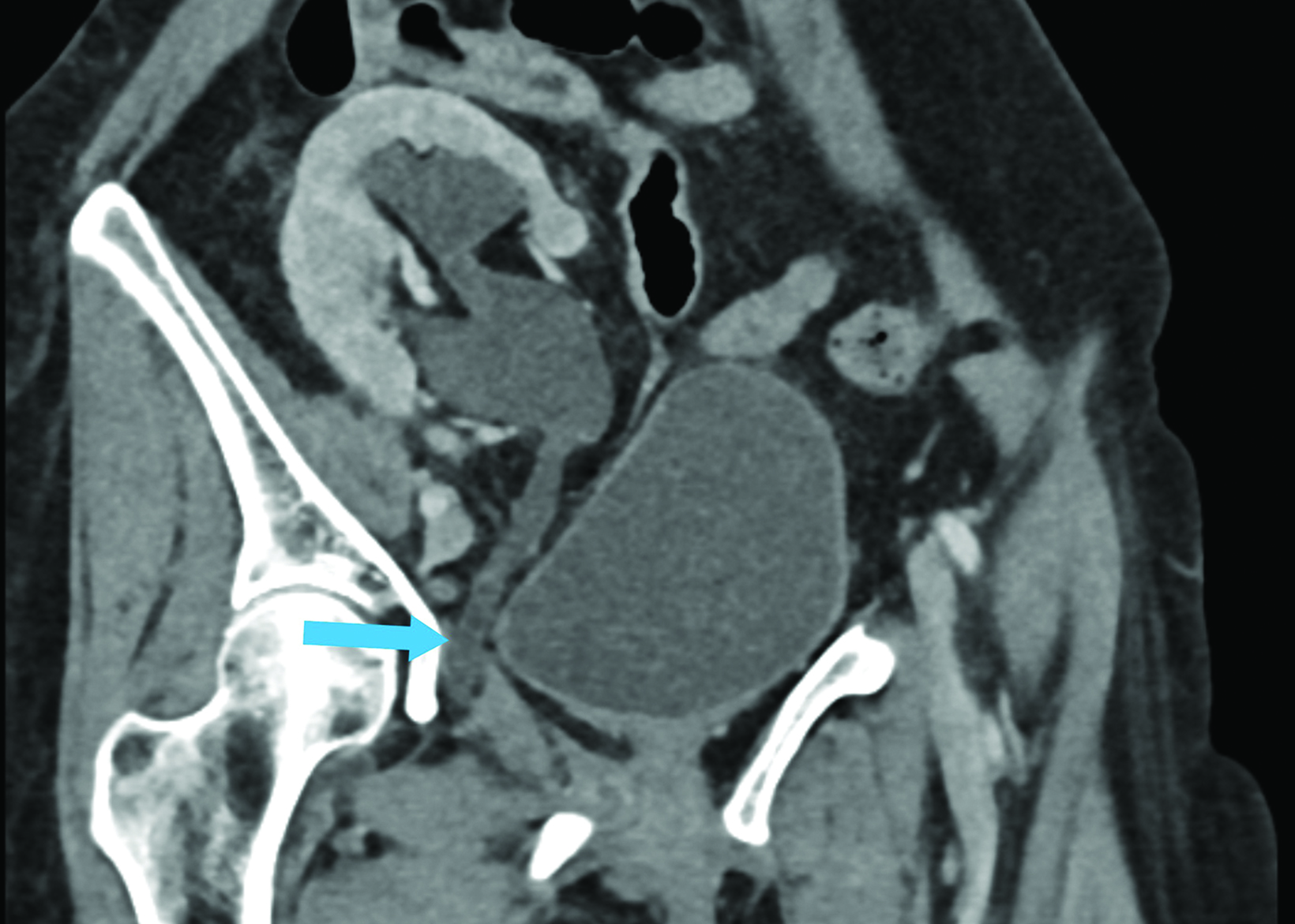 Ureteral Obturator Hernia APPLIED RADIOLOGY