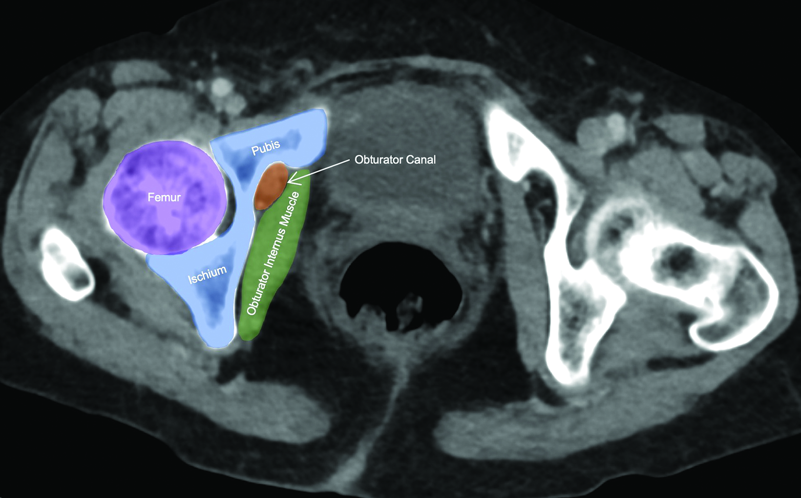 Femoral hernia, Radiology Case