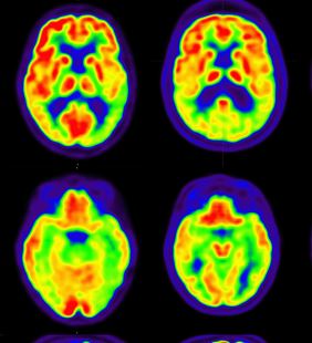 PET Scans Detect Lower Levels of Serotonin in People With Mild ...