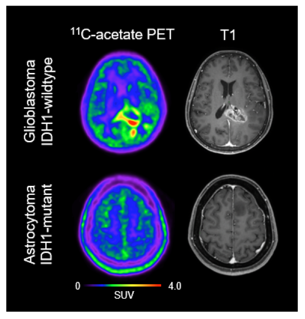 PET Imaging Technique Depicts Glioblastoma Tumor Microenvironment ...