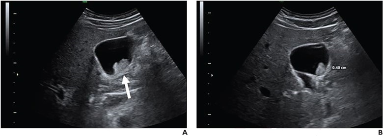 SRU Incidental Gallbladder Risk Recommendations Are Reproducible With ...