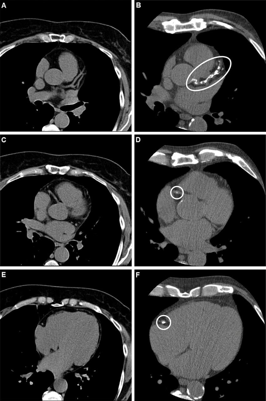 CT Coronary Artery Calcium Score Predictive of Cardiovascular Events ...