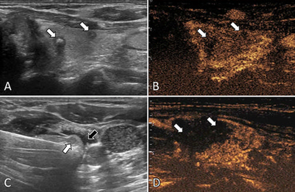 Microwave Ablation May Spare Patients From Thyroid Surgery • APPLIED ...