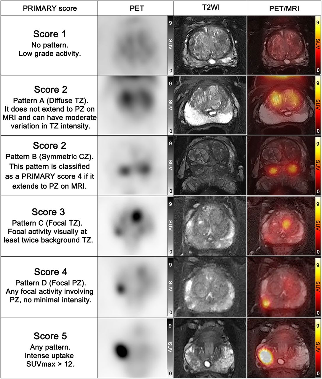 PET/MR Accurately Classifies Prostate Cancer Patients, May Help Avoid ...