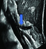 Median Arcuate Ligament Syndrome Applied Radiology