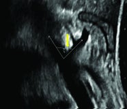 Median Arcuate Ligament Syndrome Applied Radiology