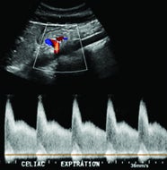 Median Arcuate Ligament Syndrome Applied Radiology