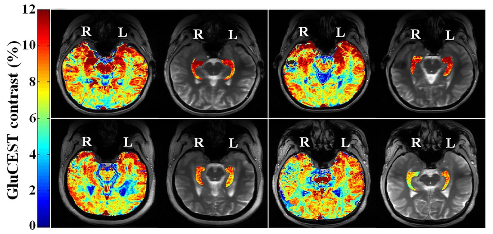 Chemical Exchange Saturation Transfer for Epilepsy Imaging | Applied ...