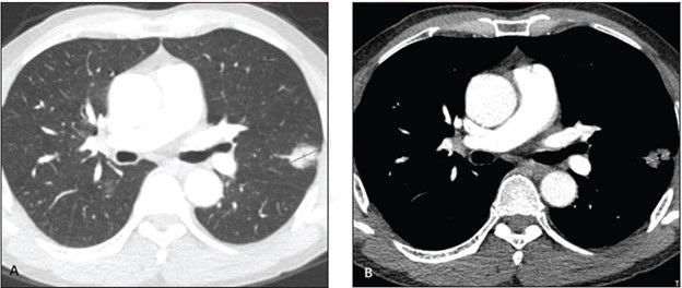 Minor Ground-glass Opacities Associated With Better Prognosis In Stage 