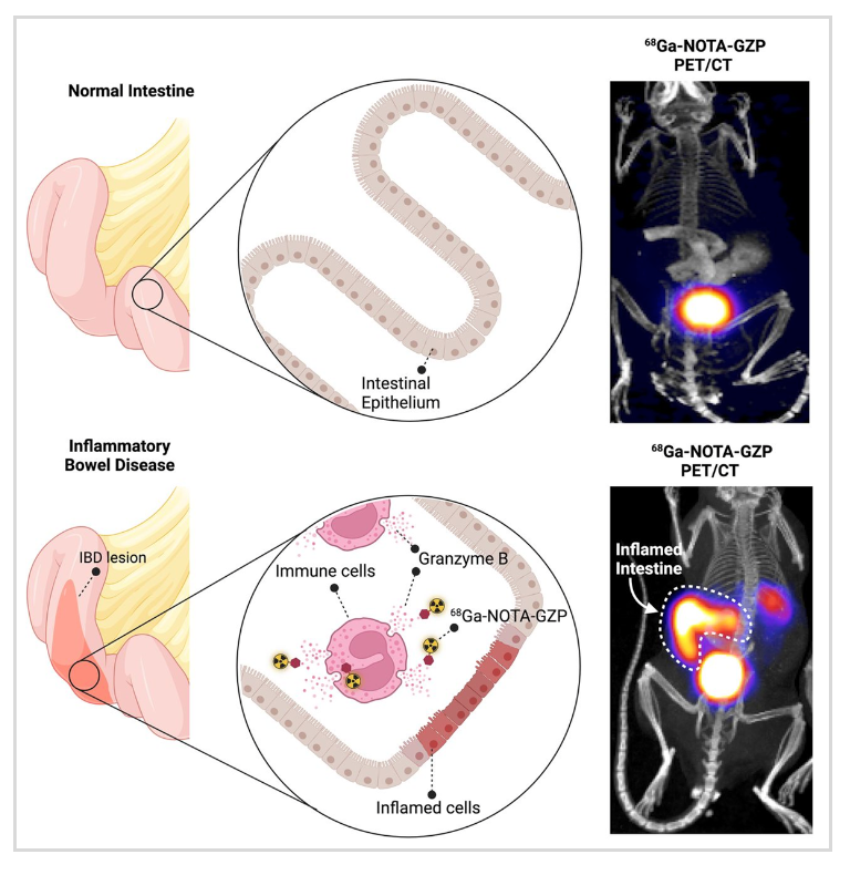 Novel PET Imaging Tool Detects Inflammatory Bowel Disease and Predicts ...