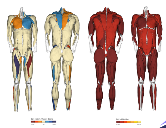 AI Solution That Analyzes Muscle Health from MR Images Nets FDA ...