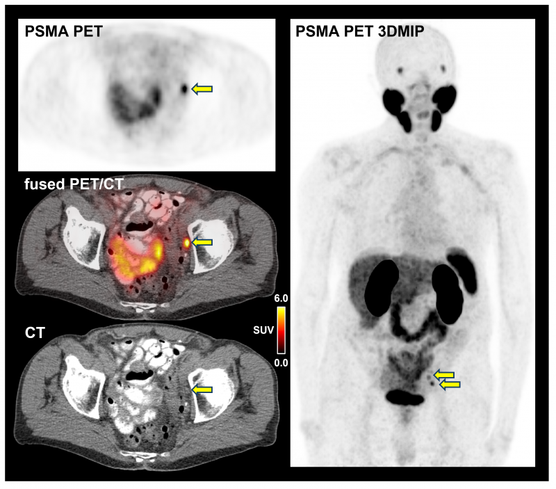 Psma PSMA-PET Uncovers Hidden Metastases in High-Risk Prostate Cancer ...