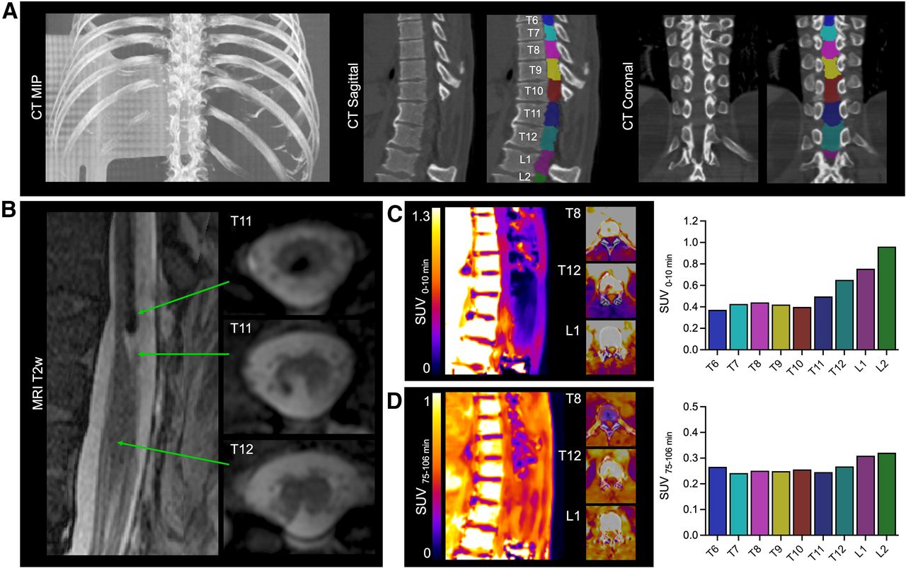 PET Tracer Provides Critical Information on Spinal Cord Injuries and ...