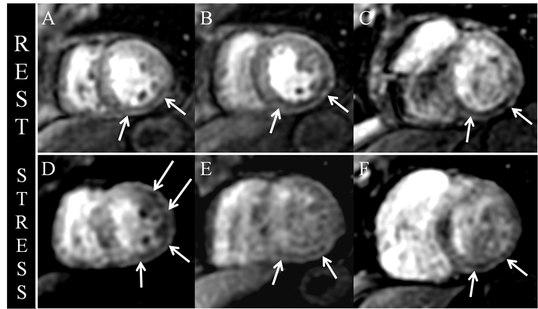 Overcoming CT-to-Body Divergence to Biopsy, Definitively Diagnose and Mark  a Subcentimeter Lesion