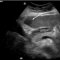 Figure 1 - Screening ultrasound demonstrating a hypoechoic HCC (arrow) in a patient with hepatitis C-related cirrhosis. This lesion was subsequently confirmed to represent HCC at biopsy.