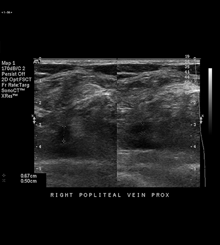 venous thrombosis ultrasound