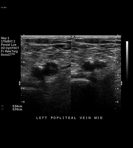 venous thrombosis ultrasound