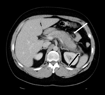 normal pancreas cat scan