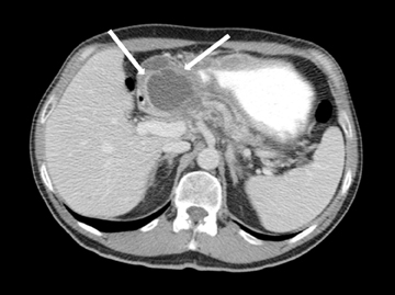 normal pancreas cat scan