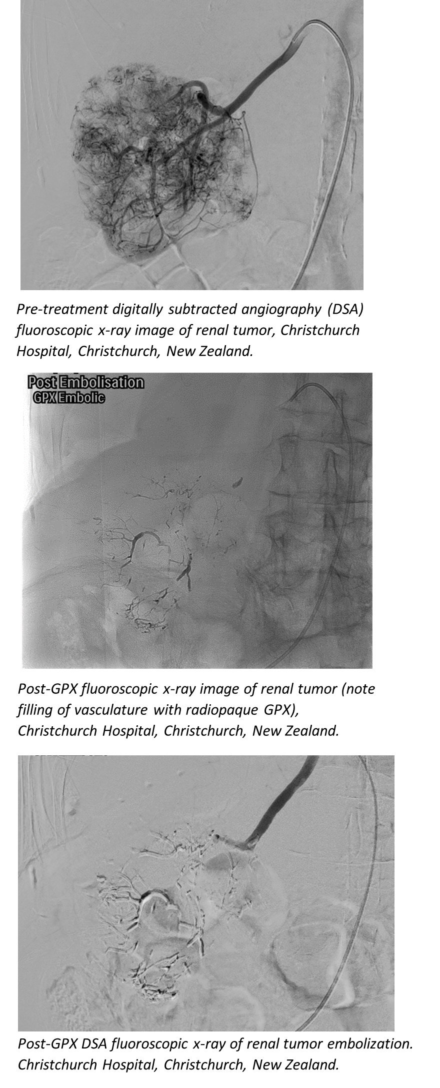 Renal Tumor Embolization Using the GPX Embolic Device, Christchurch Hospital, Christchurch, New Zealand