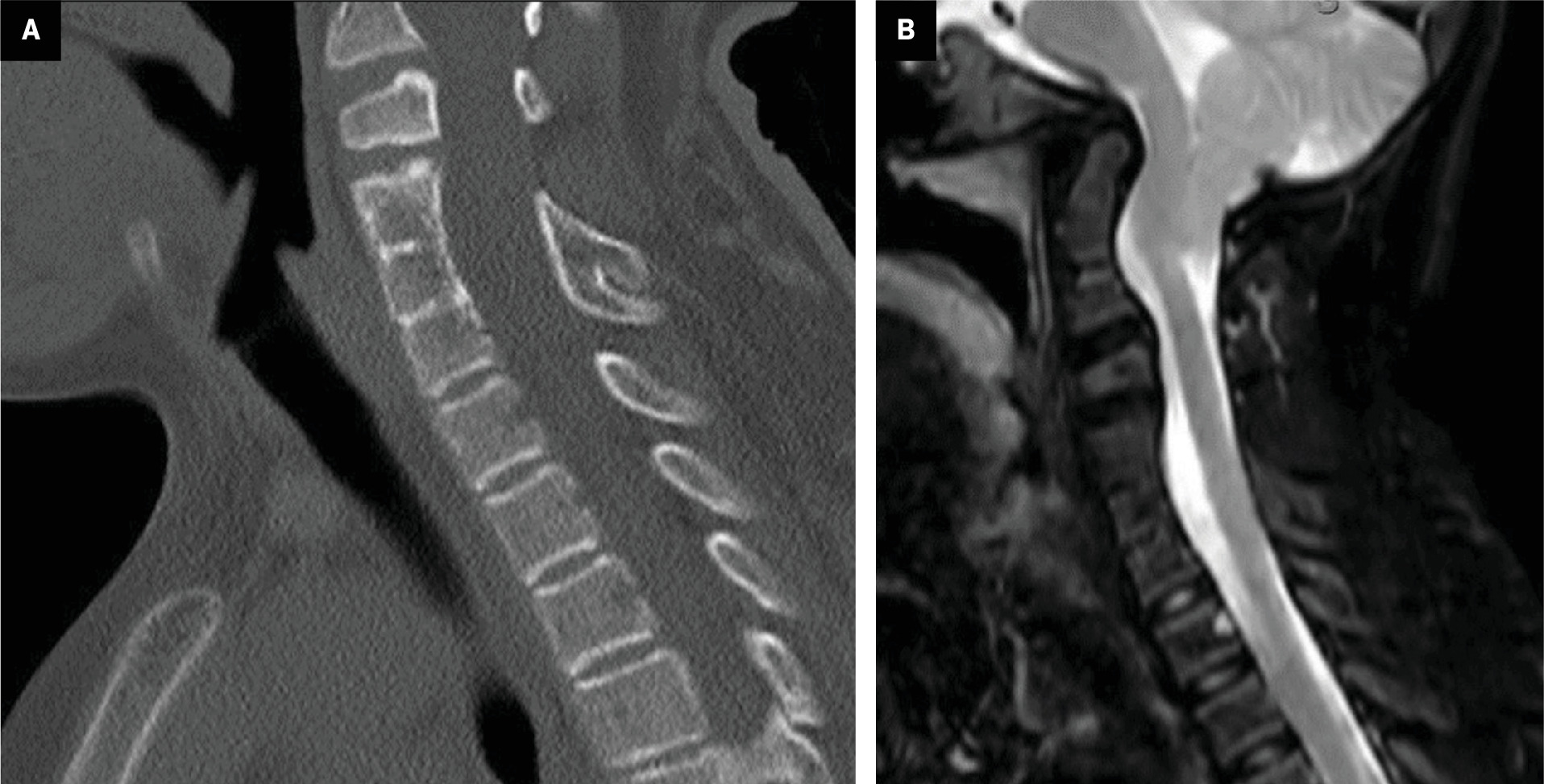 Klippel-Feil Syndrome Essentials, Part 2: Advanced Imaging Techniques and Diagnostic Strategies