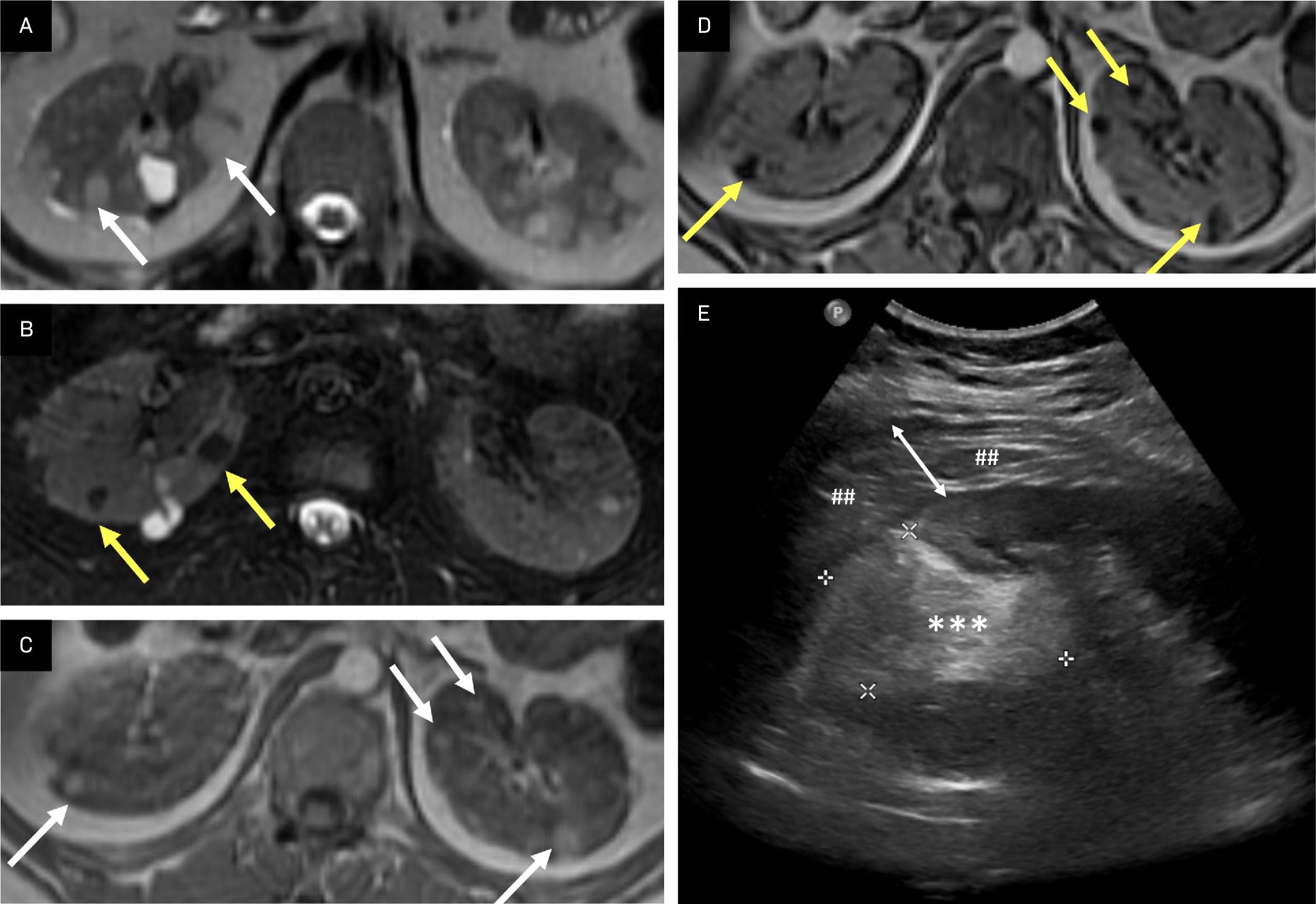 Abdominal Manifestations of Tuberous Sclerosis Complex