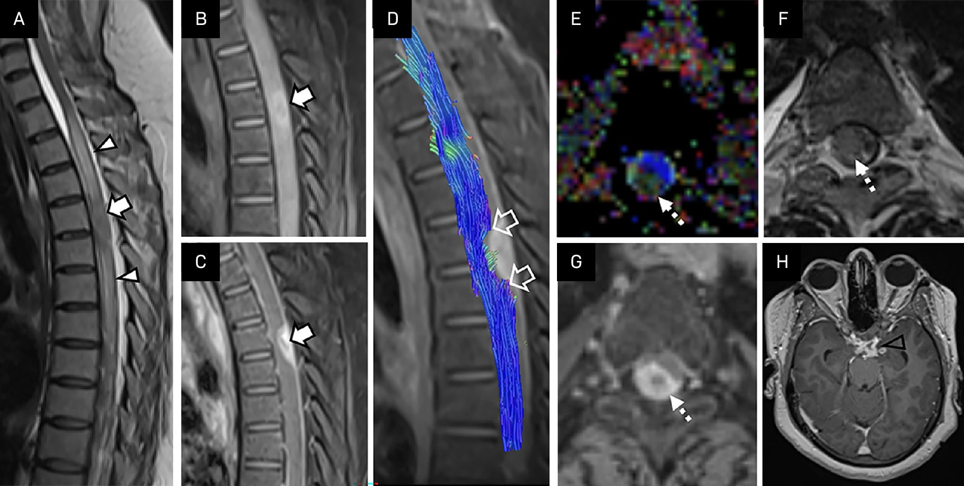 From Signals to Signs: Diffusion Tensor Imaging and Fiber Tractography ...