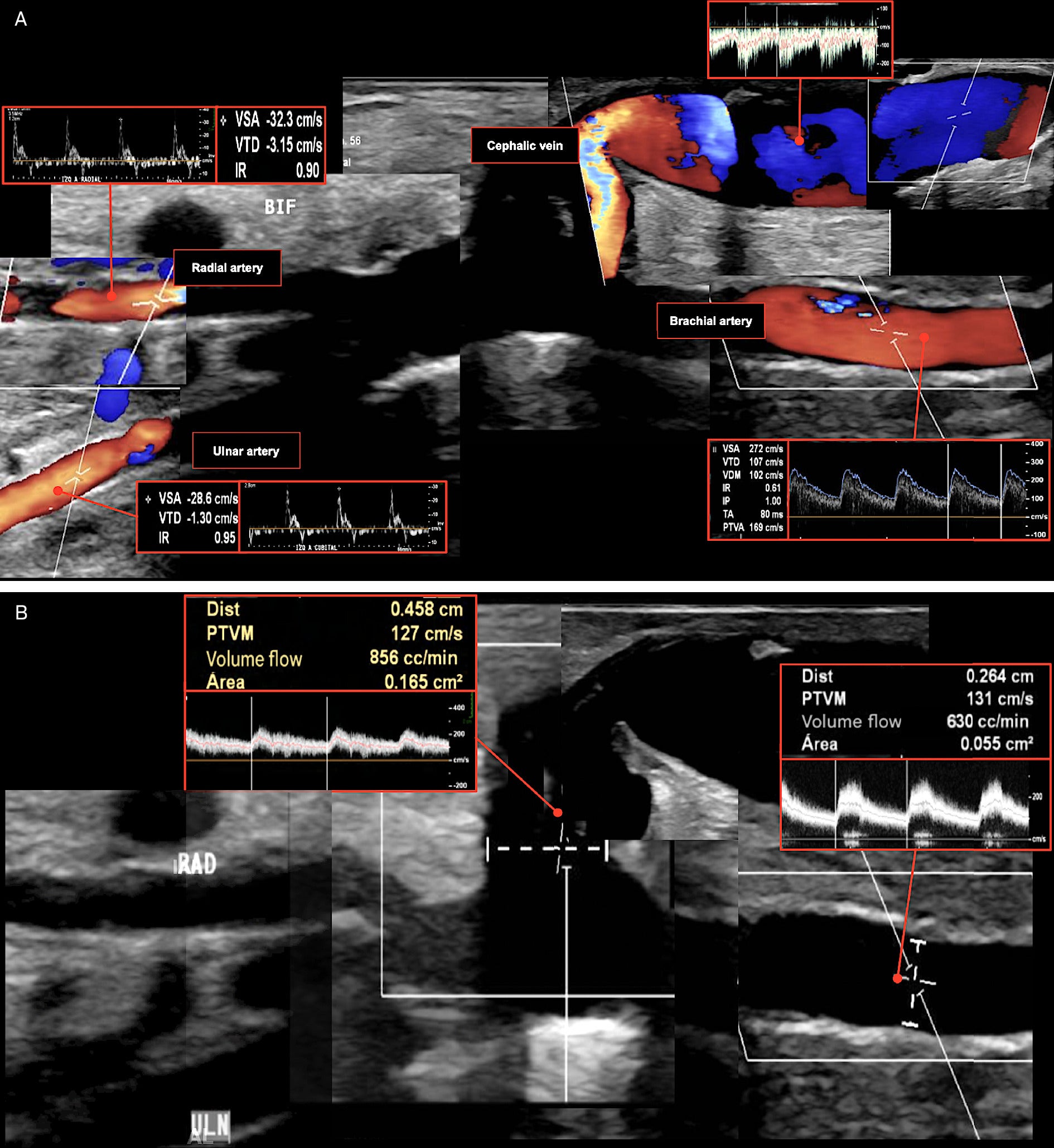 US Evaluation of Arteriovenous Fistula Complications in the Emergency ...