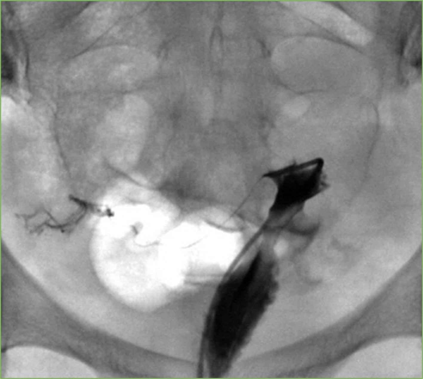 Tubal Infertility: A Review for Interventional Radiologists | Applied ...