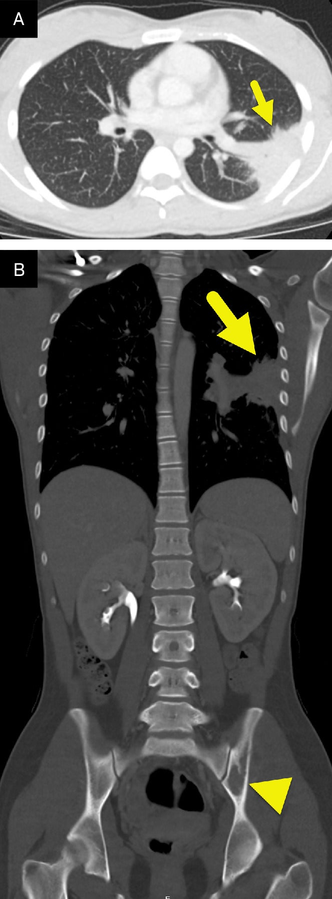 What Is Chronic Granulomatous Disease