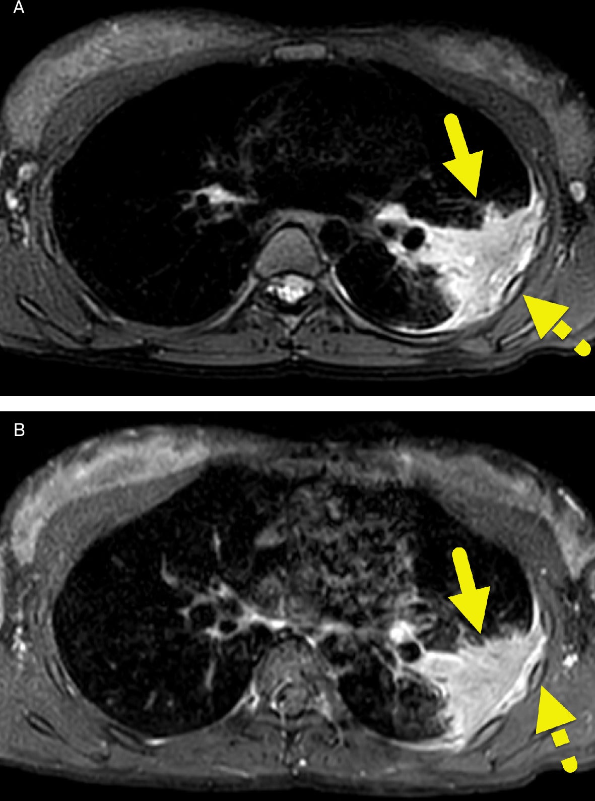 What Is Chronic Granulomatous Disease