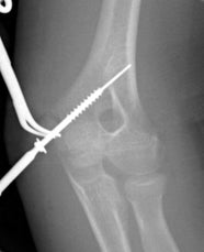 Medial Epicondyle Fracture Applied Radiology