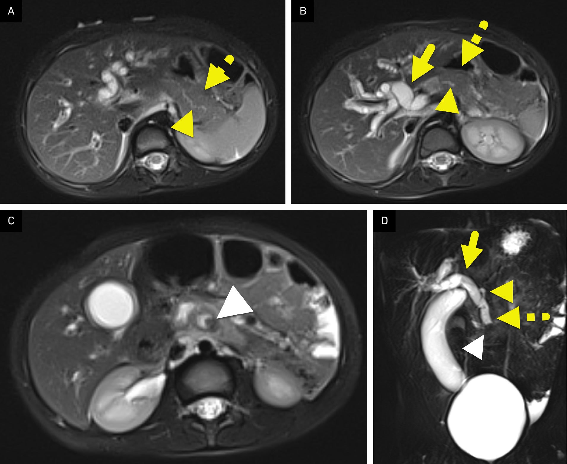 Pancreaticobiliary Maljunction | Applied Radiology