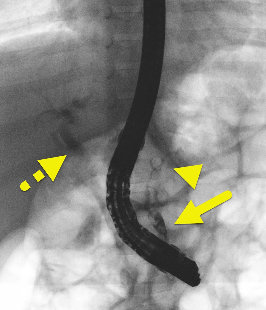 Apbj Radiology Pancreaticobiliary Maljunction | Applied Radiology