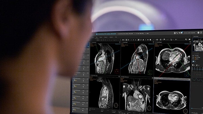 FDA Clears Philips AI Solution for Enhanced Mitral Valve Repair ...
