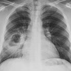 Cavitary Lung Mass