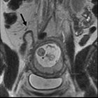 MRI Evaluation of Acute Abdominal Pain in the Pregnant Patient