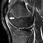 JAOCR at the Viewbox: Patellar Tendon-Lateral Femoral Condyle Friction Syndrome