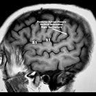 A Patterned Approach to Cerebral Gyri and Sulci for the General Radiologist 