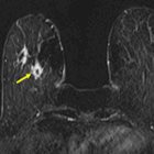 Utilization of Breast MRI for Extent of Disease in Newly Diagnosed Malignancy