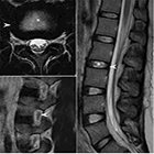 MRI Degenerative Disease of the Lumbar Spine: A Review