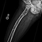 Radiographically Benign-Appearing Lesion in Child with Uptake on Bone Scan 