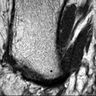 An Overview of Hindfoot Pain and MRI Findings