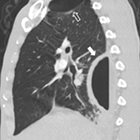 TB or Not TB: Differential Diagnosis and Imaging Findings of Pulmonary Cavities