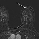 Enhancing Foci on Breast MRI